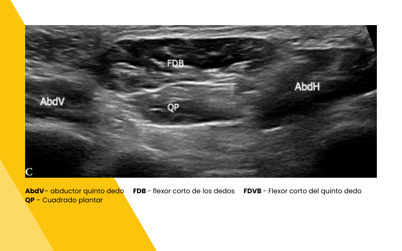 16. Musculatura intrinseca pie ecografia tempo formacion.png